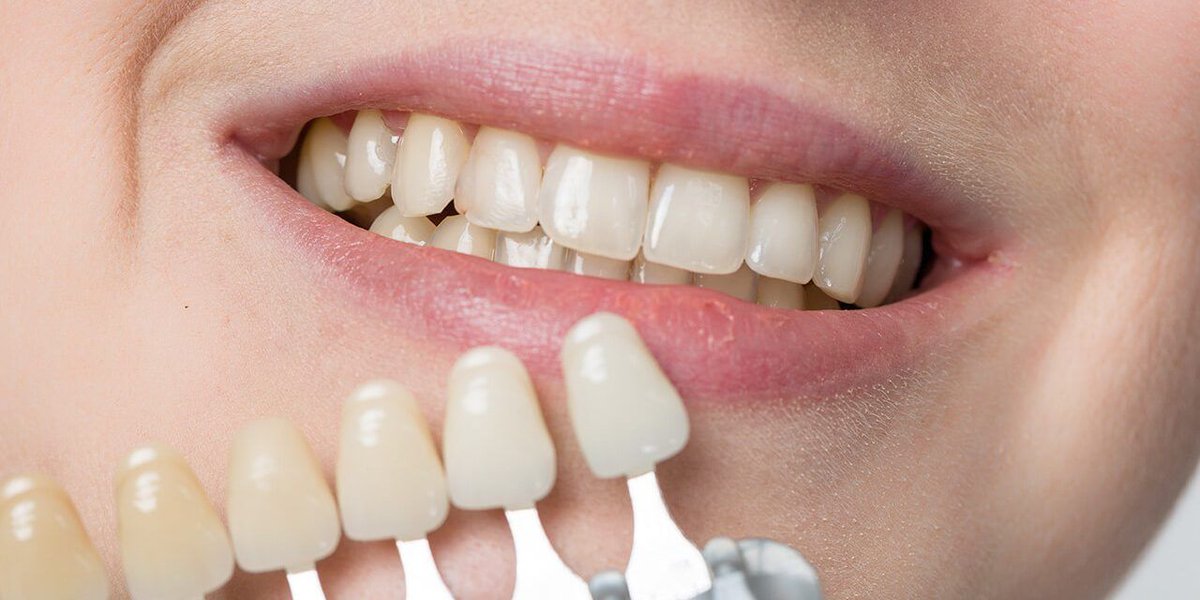 Laughing Teeth Show: Veneers make even cloudy teeth shiny again!
buff.ly/2OpoDJJ