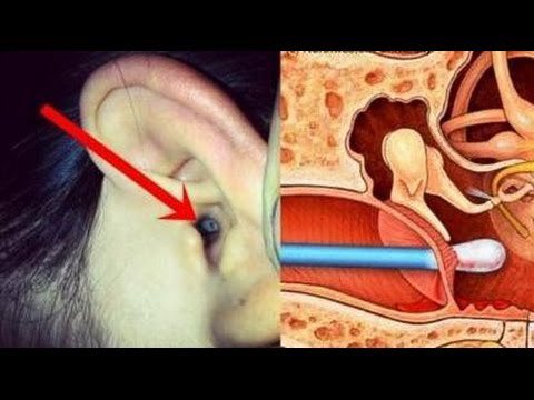 suhazeli's tweet photo. Jangan korek telinga menggunakan putik kapas komplikasinya:
🥺 putik kapas boleh tercabut dalam telinga.
🤕 boleh mencedera kan gegendang telinga.
😦 tahi telinga semakin terkumpul di dalam telinga. Merumitkan rawatan. https://t.co/uRammcYaAe