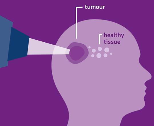 How does #ProtonBeamTherapy work? 🧐 1⃣ The beam enters the body precisely. 2⃣ Targeting the tumour, it delivers high levels of radiation. 3⃣ The beam stops when needed, sparing surrounding healthy tissue. To find out more call 0800 210 0402 or visit therutherford.com/treatments/pro…