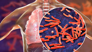 SayayRuth18's tweet photo. 24 DE MARZO: Día Mundial de la Tuberculosis 
Enfermedad devastadora y con consecuencias, sociales y económicas en quienes padecen esta enfermedad, la cual ya es prevenible y curable
#Tuberculosis #Enfermedad
@Miss_Katushka https://t.co/ca0ABJ8ozj