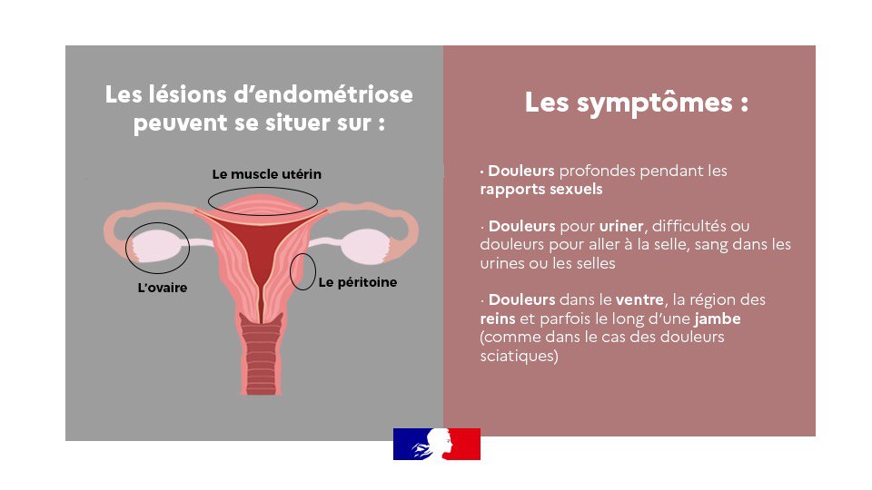 Élisabeth Moreno (@1elisamoreno) on Twitter photo L'#endometriose touche à 5 à 10% des femmes.
Trop longtemps entourée de silence, cette maladie gynécologique doit être mieux connue et mieux diagnostiquée.
Je me réjouis qu'<a href="/olivierveran/">Olivier Véran</a> ait confié à <a href="/CZacharopoulou/">Chrysoula Zacharopoulou 🇪🇺🇫🇷</a> le soin de bâtir une stratégie nationale sur ce sujet majeur. L'#endometriose touche à 5 à 10% des femmes.
Trop longtemps entourée de silence, cette maladie gynécologique doit être mieux connue et mieux diagnostiquée.
Je me réjouis qu'<a href="/olivierveran/">Olivier Véran</a> ait confié à <a href="/CZacharopoulou/">Chrysoula Zacharopoulou 🇪🇺🇫🇷</a> le soin de bâtir une stratégie nationale sur ce sujet majeur.