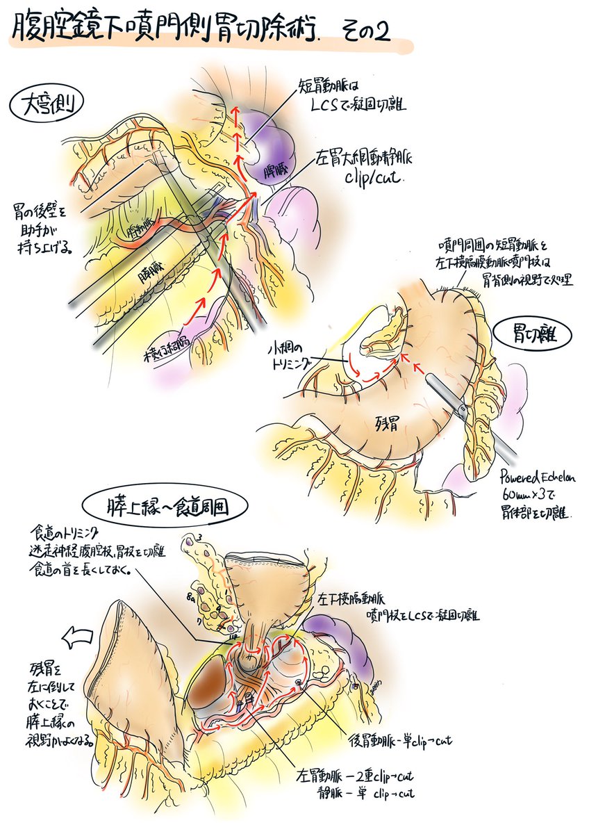 腹腔鏡下胃切除術 : 一目でわかる術野展開とテクニック 腹腔鏡下胃切除術: 一目でわかる術野展開とテクニック | 関東腹腔鏡下
