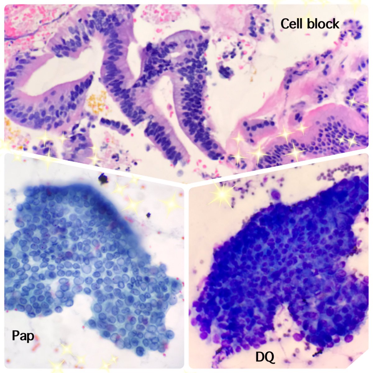 Eus-fna pancreas well diff ductal adeno. Which stain do you pick up first? #FNAfriday