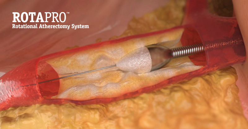 BSCCardiology's tweet photo. The #ROTAPRO Rotational Atherectomy System ablates calcium utilizing a concentric, front-cutting mechanism of action that provides precise and predictable results. 

Safety info: https://t.co/PkzvXKfpl5