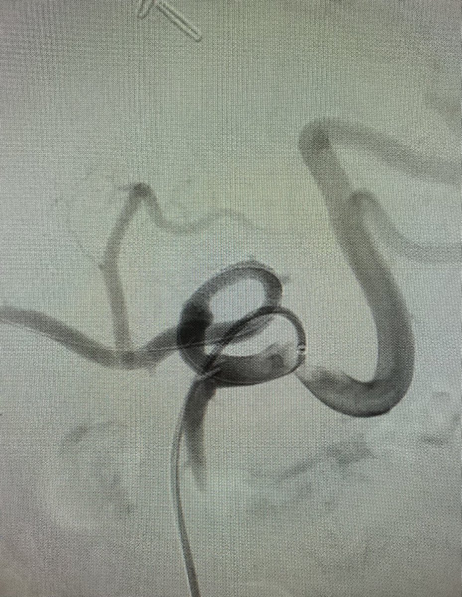 Post orthotropic liver transplant with severe transplant hepatic artery stenosis treated with <a href="/Medtronic/">Medtronic</a> Resolute Onyx coronary stent. <a href="/dotter_IR/">The Dotter Institute</a> @ir_huber @OHSUsurgery <a href="/ChrisConnellyMD/">Christopher Connelly</a> <a href="/Penn_IR/">PennIR</a> <a href="/UVA_IR/">UVA Interventional Radiology</a> <a href="/SIRspecialists/">Society of Interventional Radiology</a>