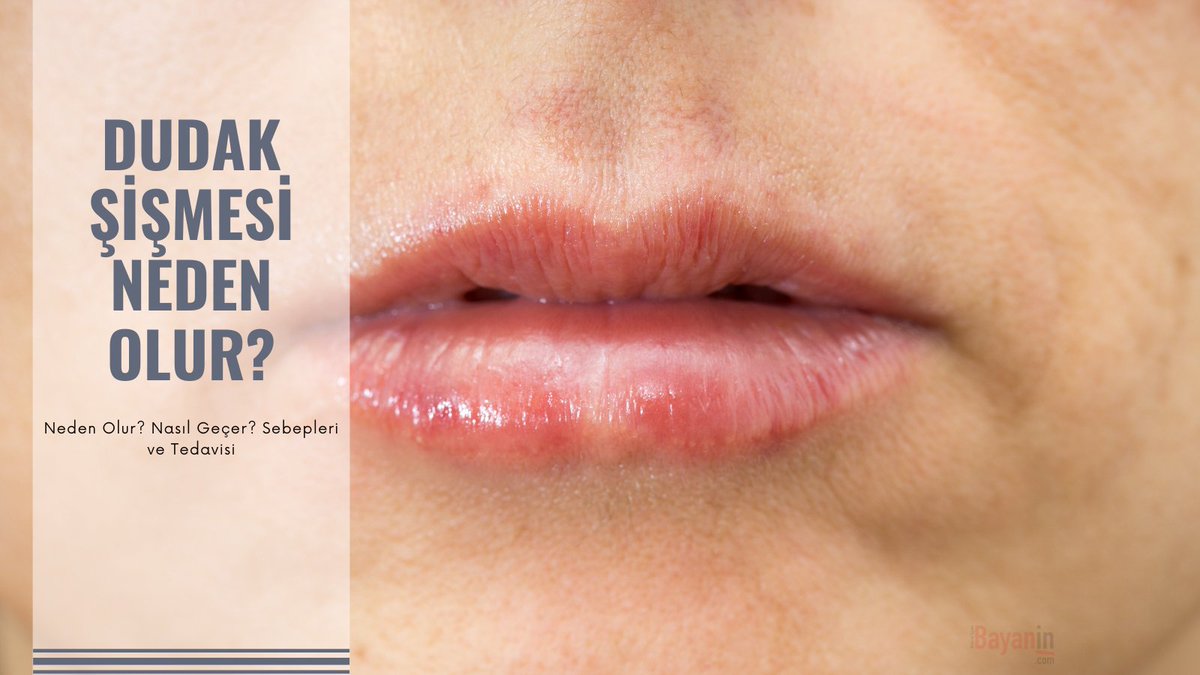 Dudak Şişmesi Neden Olur? Nasıl Geçer? | Detaylı rehber bayanin.com/dudak-sismesi #dudak #dudakşişmesi