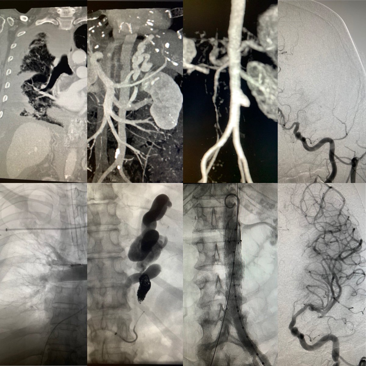 Michael J. Hsu (@mikejhsu) on Twitter photo Top Row: Pre-procedure Bottom Row: After Intervention.
4 cases in one day, left to right - Pulm Hemorrhage, CARTO of Gastric Varices, EVAR of Saccular AAA, Thrombectomy of MCA Stroke.
Thankful to be a part of the LAIIC IR team <a href="/PIHHealth/">PIH Health</a>
#TwittIR #IRad #Aorta #Stroke #MedTwitter Top Row: Pre-procedure Bottom Row: After Intervention.
4 cases in one day, left to right - Pulm Hemorrhage, CARTO of Gastric Varices, EVAR of Saccular AAA, Thrombectomy of MCA Stroke.
Thankful to be a part of the LAIIC IR team <a href="/PIHHealth/">PIH Health</a>
#TwittIR #IRad #Aorta #Stroke #MedTwitter