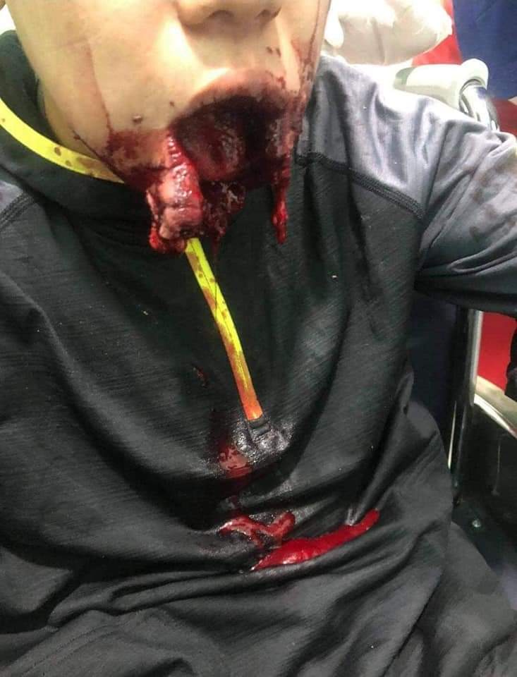 #Mar13Coup
Armed soldiers are shooting and killing people in Pyay ,today.This is a student who was shot in the mouth. Pro-democracy People are giving their lives every day.
 #WhatsHappeninglnMyanmar #CrimesAgainstHumanity