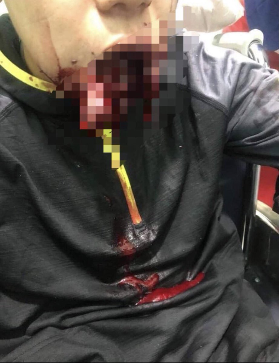 Tw // wound // blood
As terrorist junta open fire during breaking up demo, two were shot with live ammunitions and one who was ruthlessly shot in mouth was in emergency stage.
TOWARD FEDERAL UNION
#Mar13Coup
#WhatsHappeningInMyanmar <a href="/freya_cole/">Freya Cole</a> <a href="/UN_HRC/">UN Human Rights Council</a> <a href="/RapporteurUn/">UN Special Rapporteur Tom Andrews</a> <a href="/KenRoth/">Kenneth Roth</a>