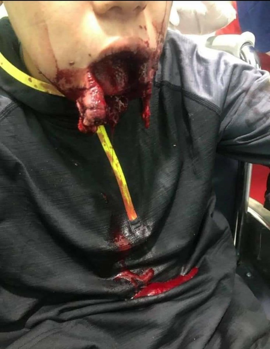 Cyck12's tweet photo. Happening Now in Pyay,the boy was shot at the entire mouth and his jaw got seriously injured while protesting this Morning.Junta's polices didn't give any warning before they shot.         #WhatsHappeningInMyanmar 
#Mar13Coup https://t.co/mzeM2sNPjV