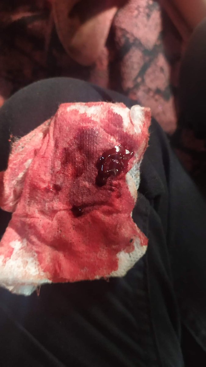 Tw//blood,death
First year student of MMU,Ko Htet Myat Aung, who was shot in stomach at Pyay Strike today  by Military's Sponsored Thugs died now. How many dead bodies  <a href="/UN/">United Nations</a> need to take actions these murders?
TOWARDS FEDERAL UNION
#WhatsHappeningInMyanmar
#Mar13Coup