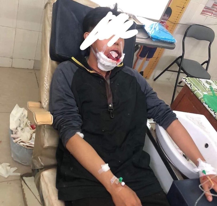 tw // gunshot, blood 

📍 Pyay
Another poor victim of severe lethal violence by terrorists. This young boy was shot in the mouth that he had severe maxillo-facial distortion. I can’t even find a word to describe their outrageous actions. #WhatsHappeningInMyanmar #Mar13Coup