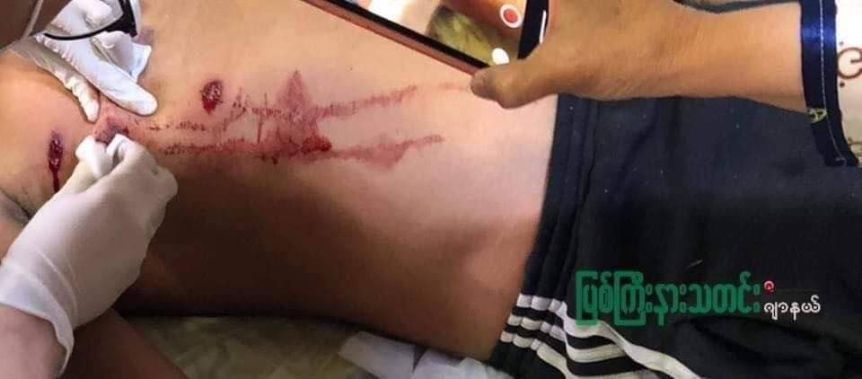Tw // wound // blood

Shooting with Rubber Bullets; This morning , Hapkant township Strike against Regime was cruelly dispersed by riot police! Two peaceful protesters were shot with rubber bullets.

TOWARDS FEDERAL UNION
#Mar13Coup
#WhatsHappeningInMyanmar