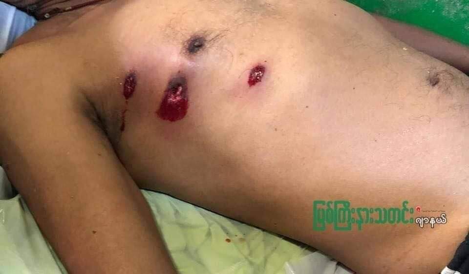 HulkPoe's tweet photo. Tw // wound // blood

Shooting with Rubber Bullets; This morning , Hapkant township Strike against Regime was cruelly dispersed by riot police! Two peaceful protesters were shot with rubber bullets.

TOWARDS FEDERAL UNION
#Mar13Coup
#WhatsHappeningInMyanmar https://t.co/3GT5sO6BLo