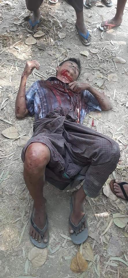 A wounded man in critical condition is seen after military crackdown a protest in Chuk, Magway region on Saturday #WhatsHappeningInMyanmar