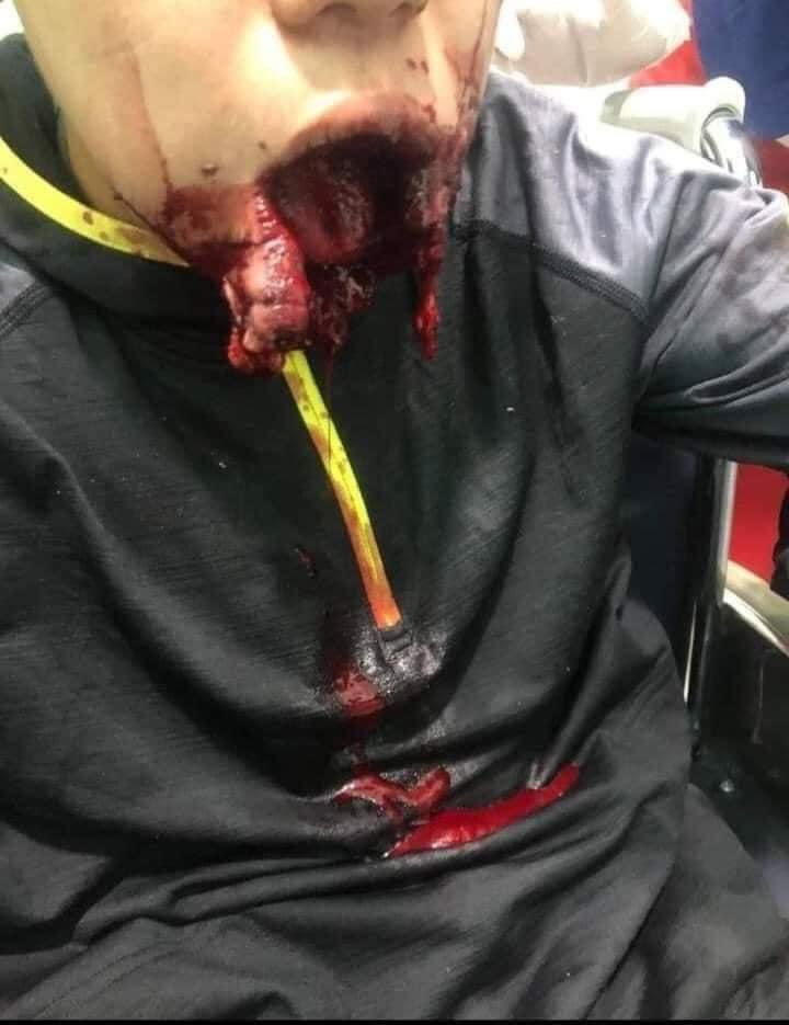 PatriciaSSNaing's tweet photo. In Pyay, the young student was shot in the mouth by military terrorists. His lower jaw got seriously injured. @UN #WhatsHappeningInMyanmar #Mar13Coup #CrimeAgainstHumanity https://t.co/sHhZ3sDW1e