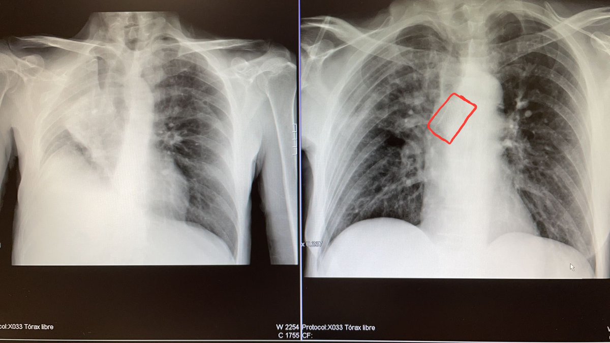 Porque #notodoescovid en la neumologia. Aqui vemos el antes y despues en la Rx y EN LA VIDA de un paciente con @cancerdepulmon tras una prótesis en bronquio ppal dcho Seguimos creciendo y avanzando en <a href="/NeumoCT/">Neumología HGU. Santa Lucía Cartagena</a> y <a href="/AnestesiaR/">AnestesiaR</a> del <a href="/Area2Cartagena/">@Area2Cartagena</a>