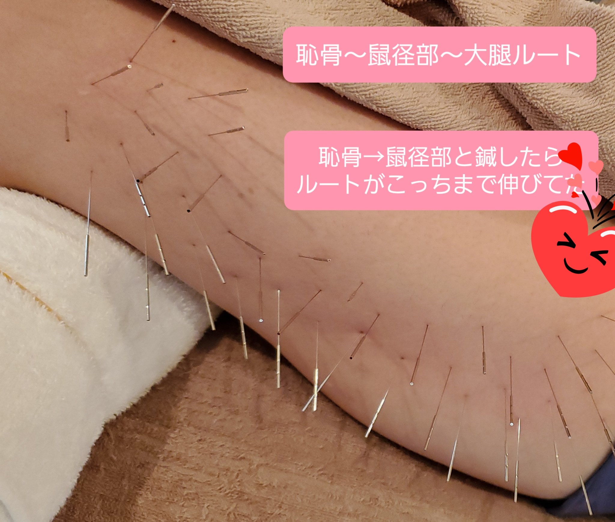恥骨部痛 Twitter Search Twitter