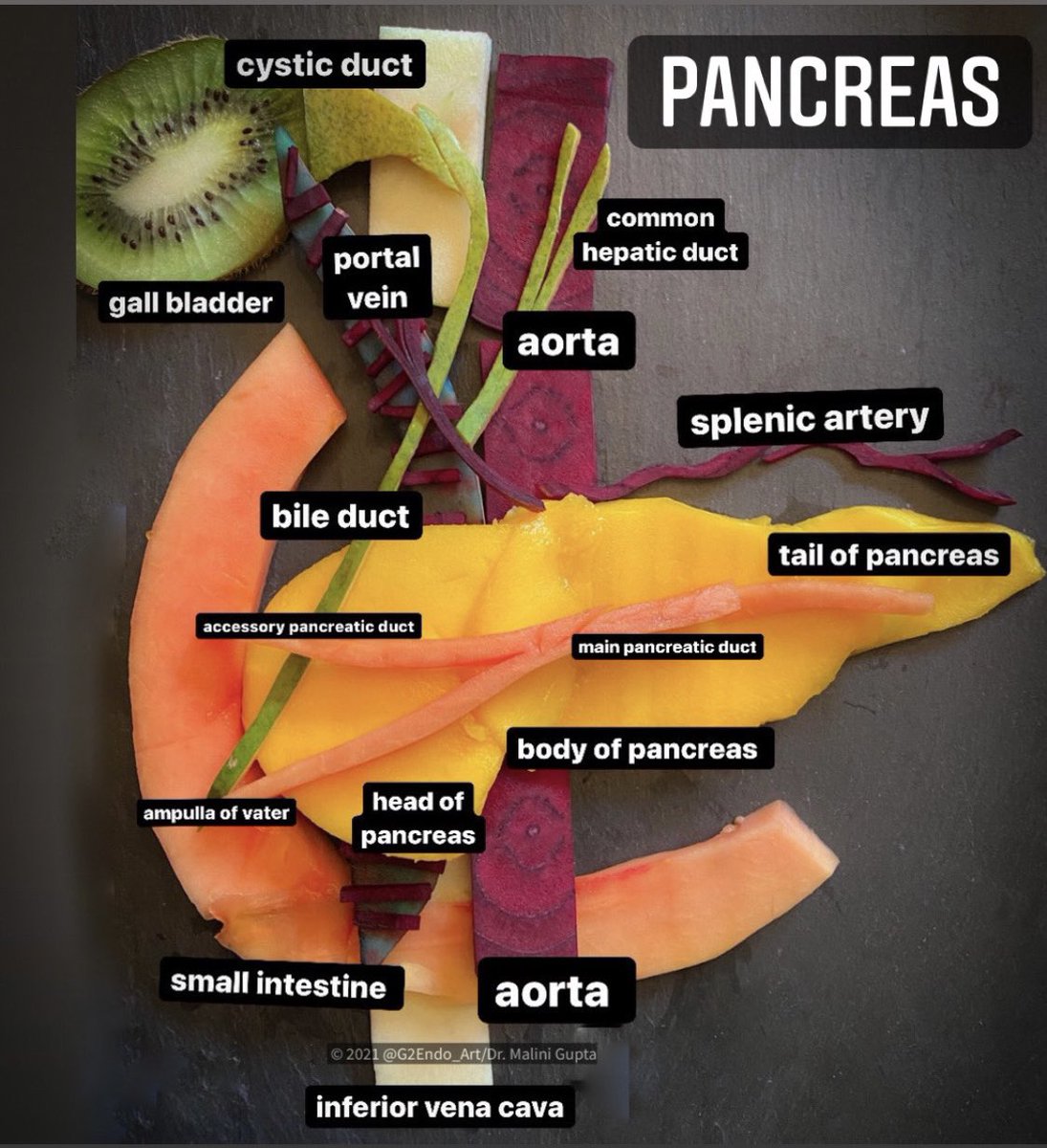 MaliniGuptaMD's tweet photo. A tribute to the organ that needs the world’s attention with the rising prevalence of diabetes.  #pancreas #diabetes #MedTwitter https://t.co/itHcLPxUdj