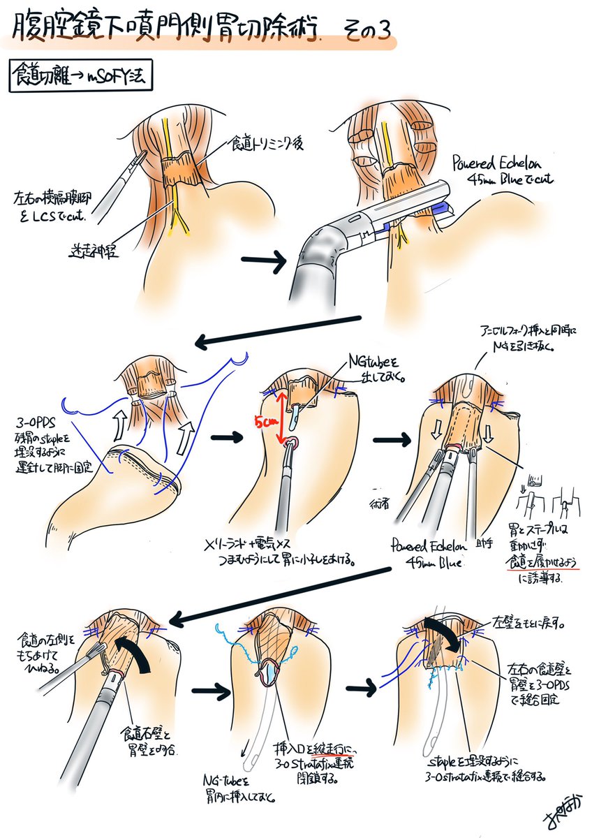 腹腔鏡下噴門側胃切除術 その3 食道切離から再建まで。再建はmSOFYです
