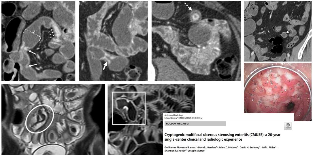 Multifocal, short, ileal strictures with stratified mural hyperenhancement in a patient with iron deficiency anemia? Consider cryptogenic multifocal ulcerous stenosing enteritis (CMUSE) as a cause of occult GI bleeding described by DFP members <a href="/JeffFidlerMD/">Jeff Fidler MD</a>  and <a href="/DavidBruiningMD/">David Bruining</a>