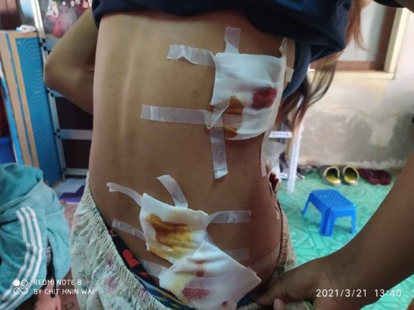 TheKiaThuta's tweet photo. tw // wound

During violent crackdown in Taunggyi, 3 unarmed civilians including one girl injured with rubber bullet shots from terrorist (SAC).

#WhatsHappeningInMyanmar  #Mar21Coup https://t.co/9WJcthx3S0