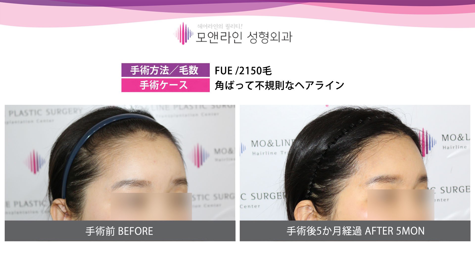 モ ヘアーライン美容整形外科 ヘアラインで顔の印象は大きく変わります たったヘアラインだけが整うだけで 小顔効果はもちろん洗練されたイメージに ヘアライン矯正 生え際矯正 毛髪移植 ミニヘアライン矯正 自毛移植 薄毛 ヘアライン 植毛