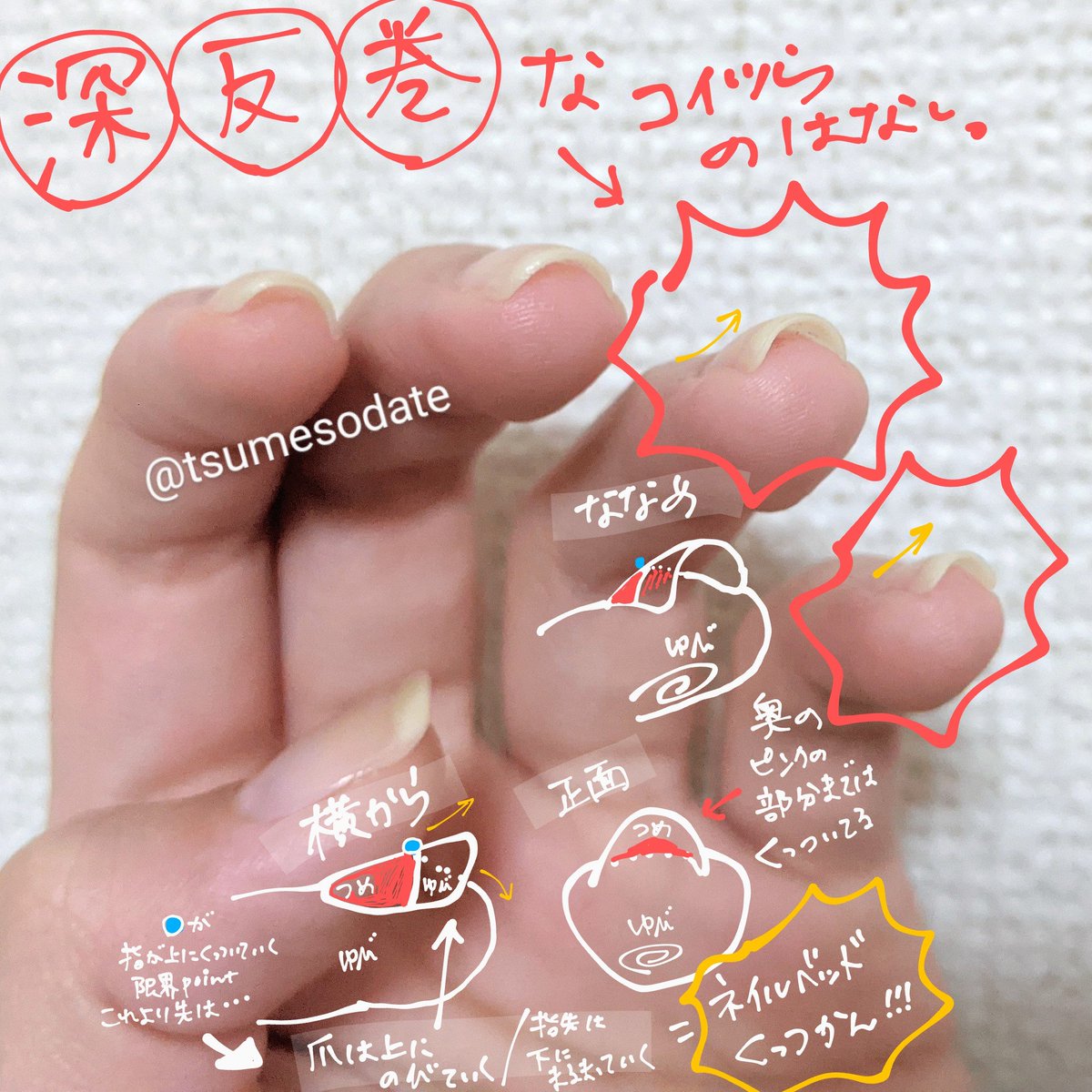 よこお 育爪 反り爪 巻き爪 深爪 深爪かつ反り爪かつ巻爪なので 爪の中というか奥まで見えます もう指がハイポに引っぱられん限り これ以上ネイルベッド伸びないというか 指と爪がくっつかんよな という話 よこお 育爪 反り爪 巻き爪 深爪 深爪かつ反り爪かつ巻爪なので 爪の中というか奥まで見えます もう指がハイポに引っぱられん限り これ以上ネイルベッド伸びないというか 指と爪がくっつかんよな という話