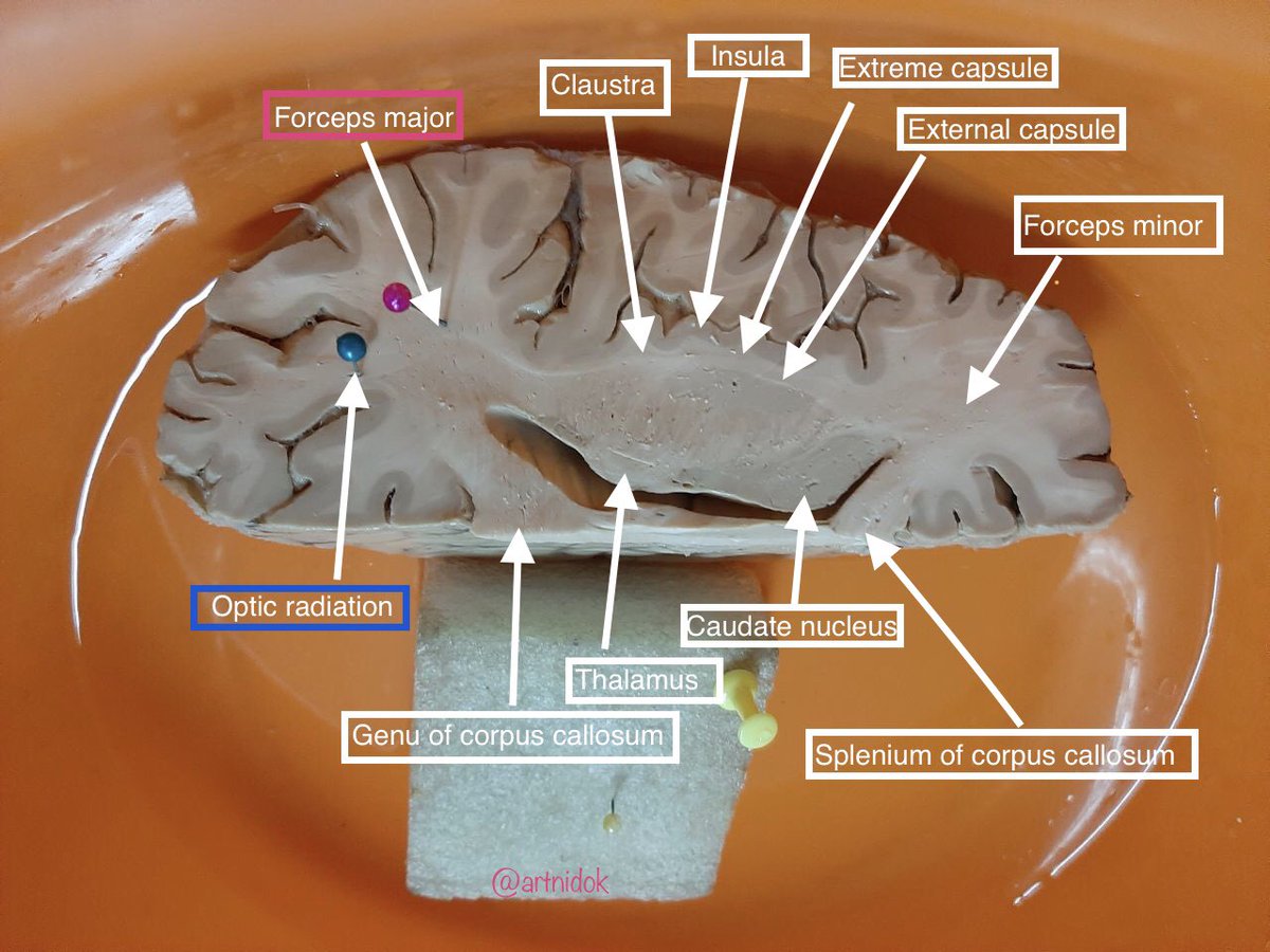 Artnidok's tweet image. Hello med freshies🤗 I’m sharing my neuroanatomy pictures I made last year for our practical exam. You can share it tooo.💛✨ 

drive.google.com/drive/folders/…