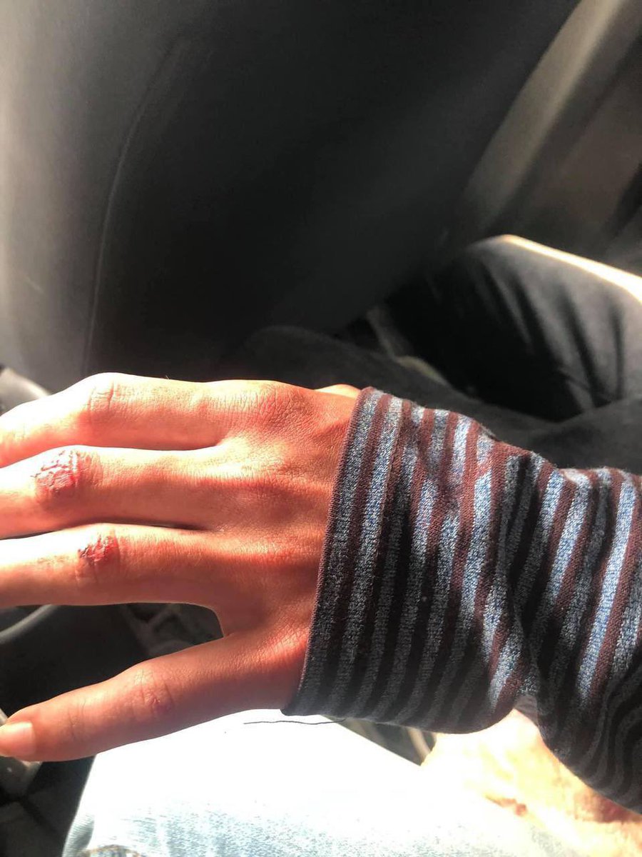John.Frenzo (@johnstifflerkzy) on Twitter photo tw // blood
In Taunggyi, Shan State, Junta’s forces used rubber bullets on peaceful protesters and seized phones & motorcycles. 
LOCOMOTIVE XYZ
#WhatsHappeningInMyanmar
#Mar14Coup tw // blood
In Taunggyi, Shan State, Junta’s forces used rubber bullets on peaceful protesters and seized phones & motorcycles. 
LOCOMOTIVE XYZ
#WhatsHappeningInMyanmar
#Mar14Coup