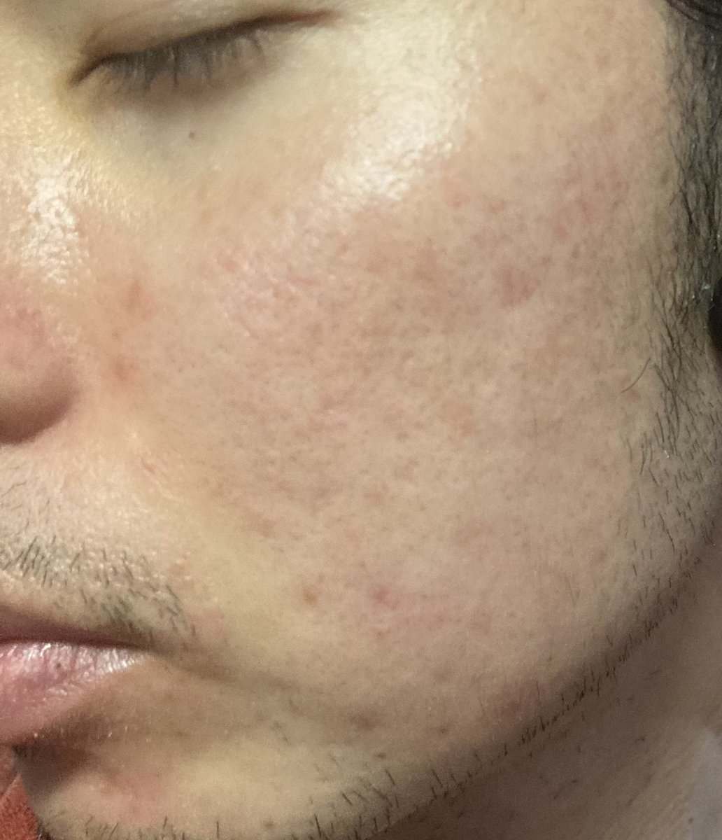 肌中心の男 肌の調子があまり良くない 最近 豚肉牛肉を毎日食べているからだろうか あまり気にしてなかったけど 鶏胸肉を食べ てる時は肌が好調で それらを豚肉牛肉に変えると髭剃り後のニキビの発生率も上がっている気がする 肌中心の男 肌の調子があまり良くない 最近 豚肉牛肉を毎日食べているからだろうか あまり気にしてなかったけど 鶏胸肉を食べ てる時は肌が好調で それらを豚肉牛肉に変えると髭剃り後のニキビの発生率も上がっている気がする