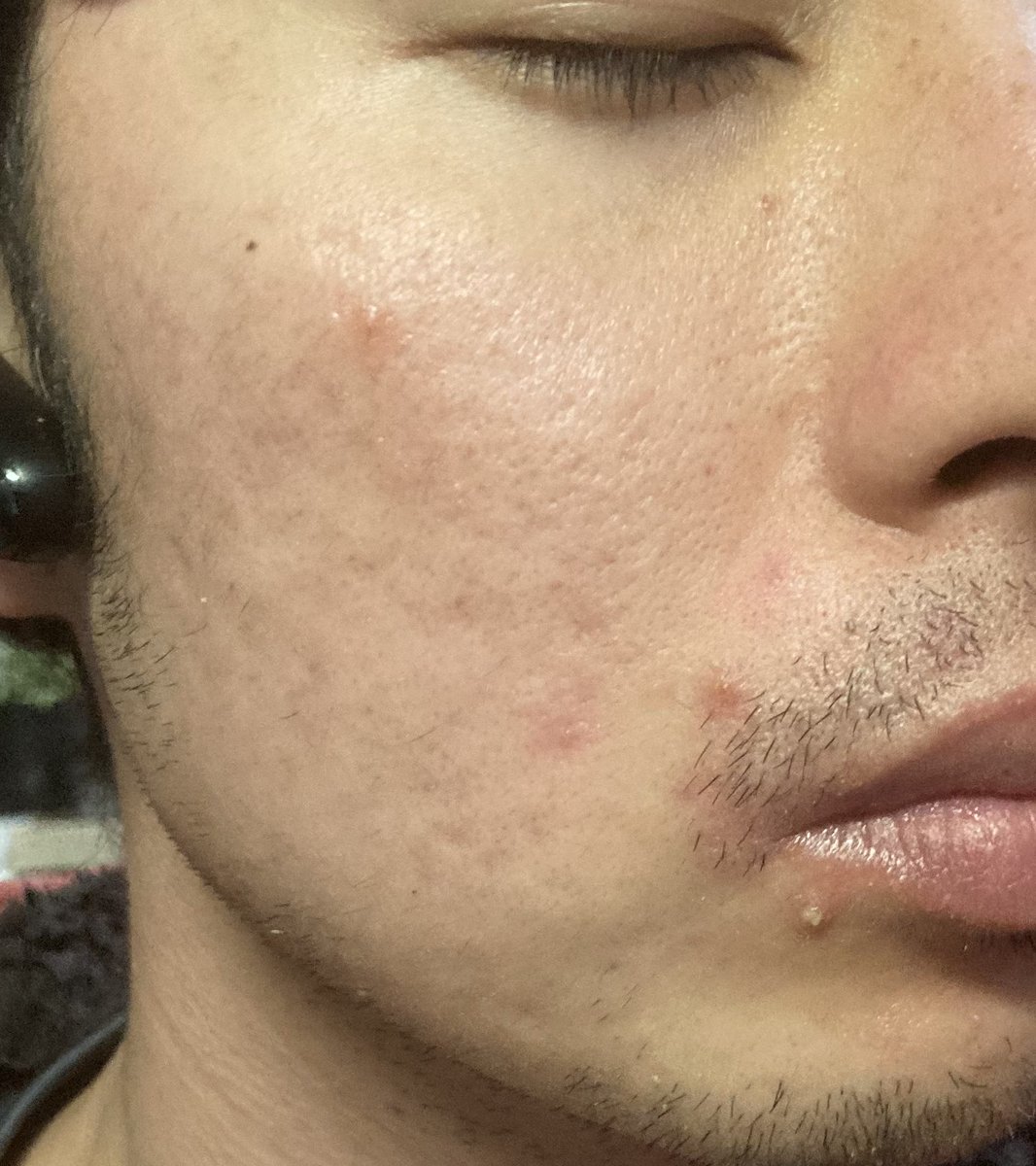 肌中心の男 肌の調子があまり良くない 最近 豚肉牛肉を毎日食べているからだろうか あまり気にしてなかったけど 鶏胸肉を食べ てる時は肌が好調で それらを豚肉牛肉に変えると髭剃り後のニキビの発生率も上がっている気がする 肌中心の男 肌の調子があまり良くない 最近 豚肉牛肉を毎日食べているからだろうか あまり気にしてなかったけど 鶏胸肉を食べ てる時は肌が好調で それらを豚肉牛肉に変えると髭剃り後のニキビの発生率も上がっている気がする