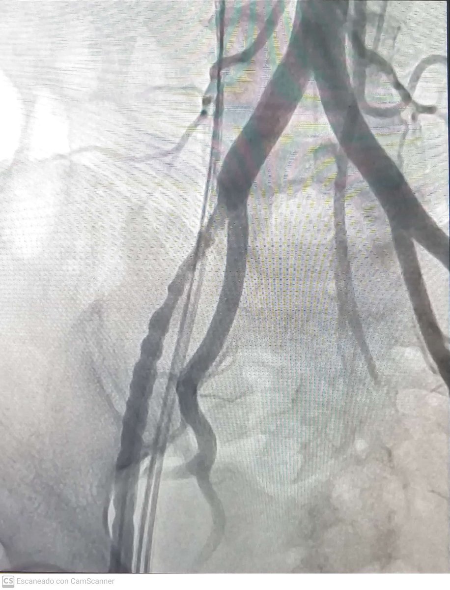 📌Paciente mujer de 43 años que durante un EEF y ablación presentó dolor abdominal intenso. La angiografía reveló displasia fibromuscular asociada a espasmo de la arteria femoral. <a href="/ManlioMarquez/">Manlio Márquez Murillo</a>