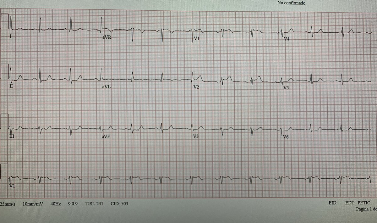 #ECGchallenge 👩🏻‍🦰 46 y/o. Dyslipemia, 🚬, gestational diabetes. Admitted to the ER complaining CP @brun_dav @The_Nanashi_O @PacoDardon @AslangerE @BrooksWalsh @rob_buttner @ecgrhythms @Elena_GRuberte