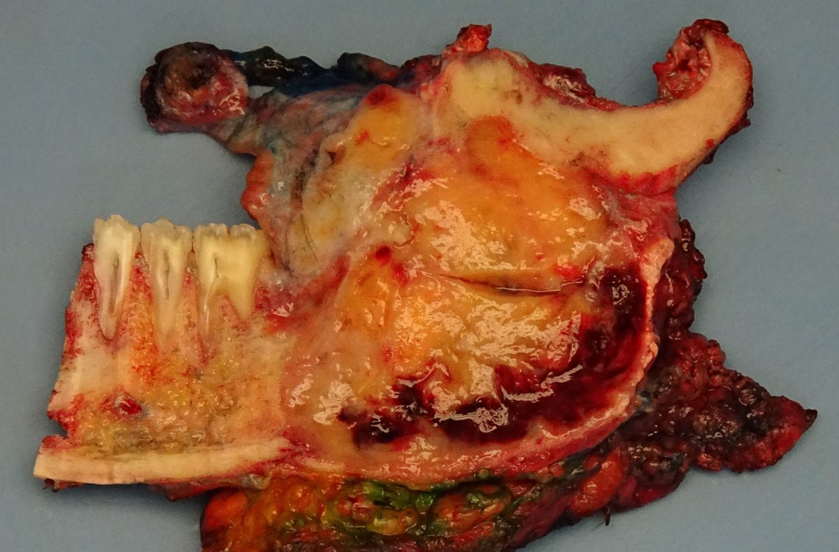 BinXu16's tweet photo. Sharing an interesting mandibular mass. #ENTpath #HEADNECKpath #oralpath Mandibular mass in a mid-age patient. IHC is CK AE1/AE3

@kriyer68 @Histopatolomon @DrGeeONE @ariella8 @sam_albadri @HENRYY_MD @AnnieMcLeanDMD @JohnsonThomasMD https://t.co/AUUWXAnDtf