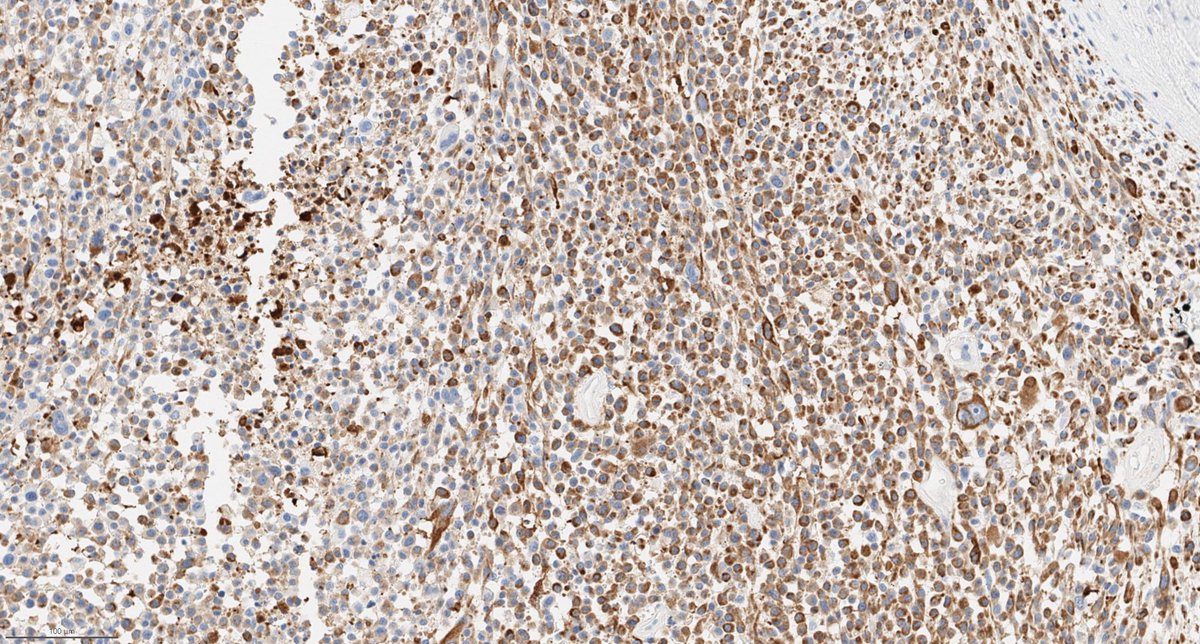 Bin Xu (@binxu16) on Twitter photo Sharing an interesting mandibular mass. #ENTpath #HEADNECKpath #oralpath Mandibular mass in a mid-age patient. IHC is CK AE1/AE3
<a href="/kriyer68/">Kalyani Bambal</a> <a href="/Histopatolomon/">Pascual Meseguer</a> <a href="/DrGeeONE/">Olaleke Folaranmi</a> <a href="/ariella8/">Celina Stayerman MD</a> <a href="/sam_albadri/">Sam Albadri, M.D., M.Sc.</a> <a href="/HENRYY_MD/">Henry YANG</a> @AnnieMcLeanDMD <a href="/JohnsonThomasMD/">Johnson Thomas, MD, FACE</a> Sharing an interesting mandibular mass. #ENTpath #HEADNECKpath #oralpath Mandibular mass in a mid-age patient. IHC is CK AE1/AE3
<a href="/kriyer68/">Kalyani Bambal</a> <a href="/Histopatolomon/">Pascual Meseguer</a> <a href="/DrGeeONE/">Olaleke Folaranmi</a> <a href="/ariella8/">Celina Stayerman MD</a> <a href="/sam_albadri/">Sam Albadri, M.D., M.Sc.</a> <a href="/HENRYY_MD/">Henry YANG</a> @AnnieMcLeanDMD <a href="/JohnsonThomasMD/">Johnson Thomas, MD, FACE</a>