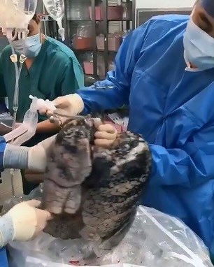 FirstDoctor's tweet photo. After smoking for 30 years, a 52-year-old man’s lungs look like this.. https://t.co/OoOv6lPcB7