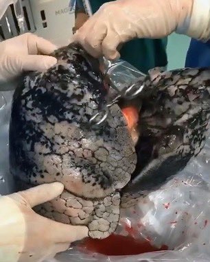 FirstDoctor's tweet photo. After smoking for 30 years, a 52-year-old man’s lungs look like this.. https://t.co/OoOv6lPcB7