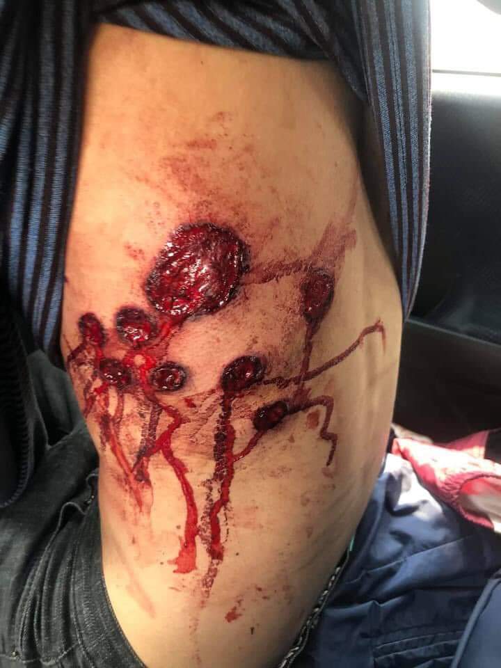 Pyitheinkyaw9's tweet photo. TW // blood , gunshot wound 
Location - Taunggyi , shan state , Myanmar. Junta’s forces used rubber bullets on peaceful protesters and also seized phones &amp; motorcycles . 
@RapporteurUn
 
LOCOMOTIVE XYZ 
#Mar14Coup #WhatsHappeningInMyanmar https://t.co/yTKG1atmkF
