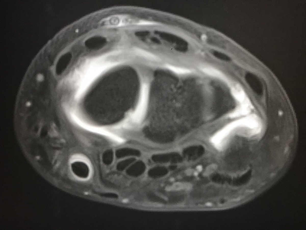 MskRadUHS's tweet photo. Can someone with better anatomy knowledge than me tell me why there is contrast in the FCR tendon sheath after a dorsal radiocarpal compartment arthrogram? #foamrad  #MSKrad https://t.co/m1OjzIDKMy
