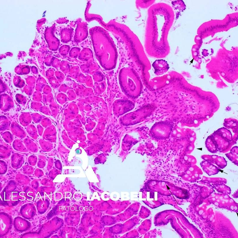 DrAlessandroIac's tweet photo. #intestinalmetaplasia in gastric epithelium #biopsy. Intastinal metaplasia is a #precancerous lesion of the stomach. It must be reported to stratify the oncologic risk of the patient and to program a follow-up. #GIpath #gepath #iapath #risk #stomach #gastricbiopsy #oncologicrisk https://t.co/TeIgvUDPAy