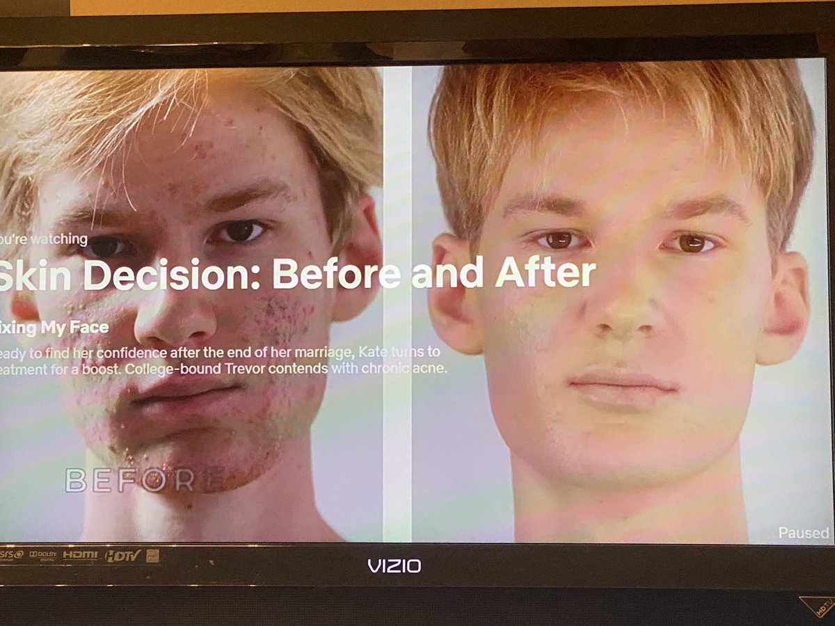 NGordon's tweet image. I absolutely love the show #SkinDecisionBeforeandAfter. They get great results. I just wish they would stop putting makeup on the afters. #NotNecessary
