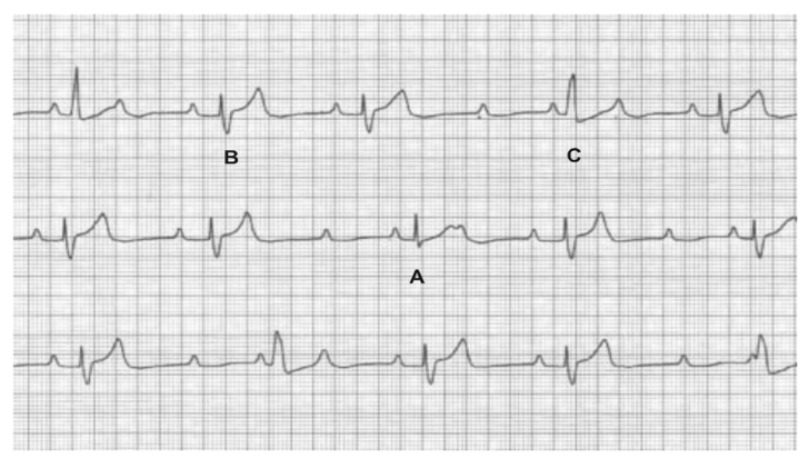 Este ECG es similar al que muestra <a href="/SergioPinski/">Sergio Pinski</a> el latido que parece mejor conducido A en realidad es un fusion