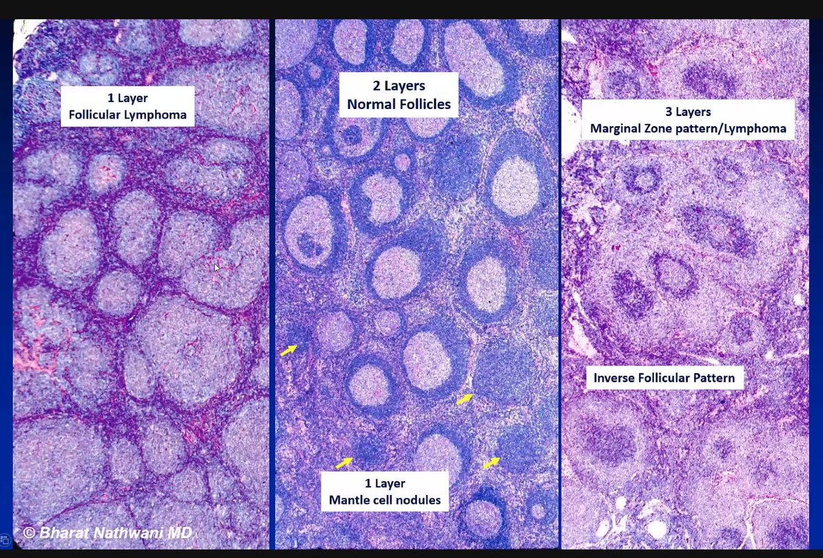 Dr. Nathwani explaining patterns of lymphomas <a href="/AIPNAPathology/">AIPNA</a> #USCAP2021