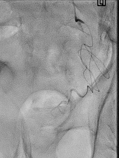gaxray's tweet photo. Perseverance: PAE possible in anterior division internal iliac origin occlusion. Dominant left prostate artery catheterized via collaterals. Strong clinical indication (BPH-LUTS, catheter dependent, severe hematuria) #BPH #PAE https://t.co/mY48nlyoqN