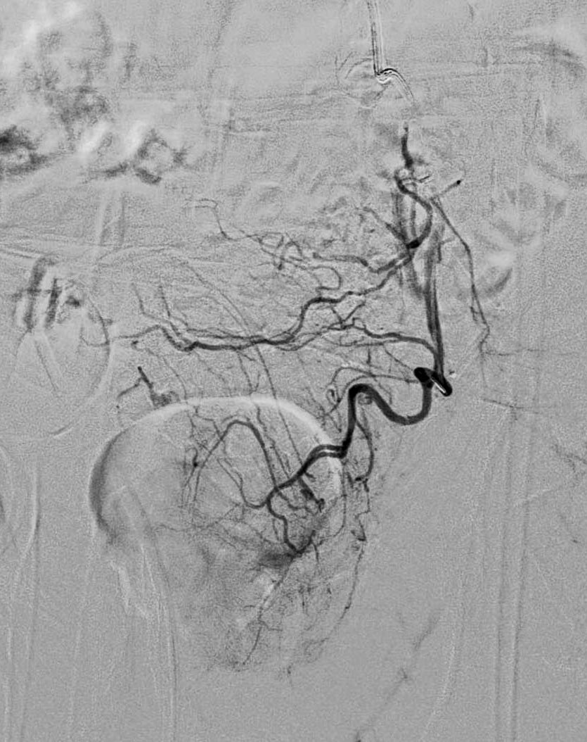gaxray's tweet photo. Perseverance: PAE possible in anterior division internal iliac origin occlusion. Dominant left prostate artery catheterized via collaterals. Strong clinical indication (BPH-LUTS, catheter dependent, severe hematuria) #BPH #PAE https://t.co/mY48nlyoqN