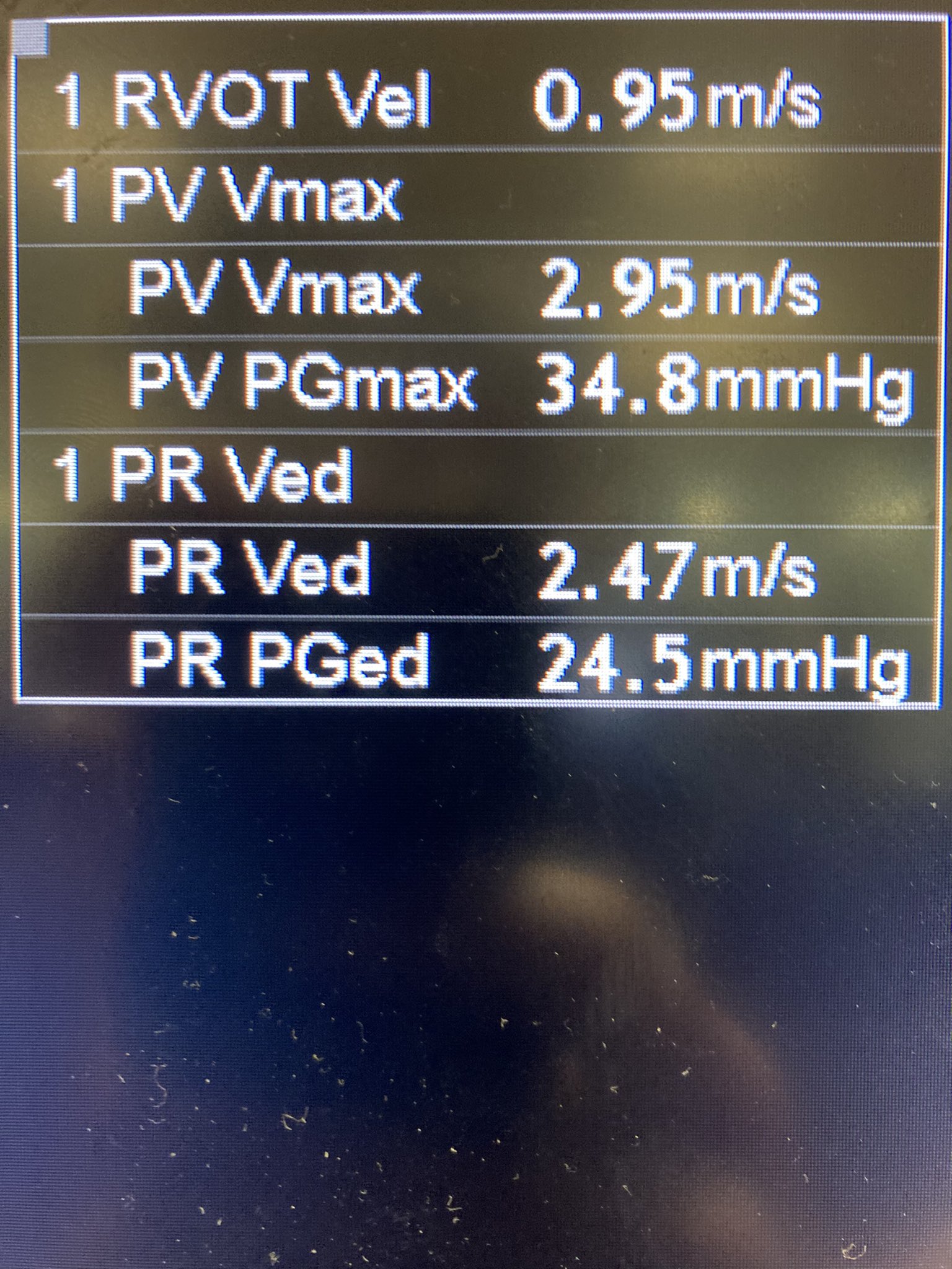 Korbinhaycockmd Thinkingcc Farid Jalali Cameronks Srrezaie 1 These Are Prior To Treatment Other Than The Rvot Notch Note The Lowish E E And High End Diastolic Pressure Gradient Ivc Was Plethoric Too Indicating