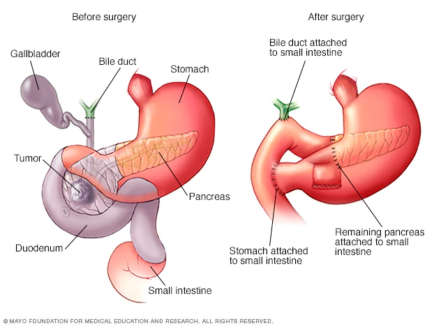 NatPancFdn's tweet image. WHIPPLE PROCEDURE

The Whipple procedure may also be used to treat some benign pancreatic lesions and cysts and cancers in the bile duct and beginning part of the small intestine (duodenum).

RESOURCE LINK:
pancreasfoundation.org/patient-inform…

#whippleprocedure #pancreas #pancreasdisease