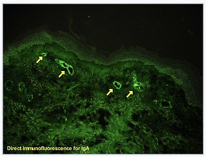 polysciences's tweet image. New #Fixation on #Histology blogpost on #fluorogenic &amp;amp; #chromogenic #IHC labels from @NS4Histotech:
bit.ly/HistIHC
Image credit Wikipedia, Emmanuelm: bit.ly/WikiIHC
#MicroscopyMonday #histology #fluorescence #pathology