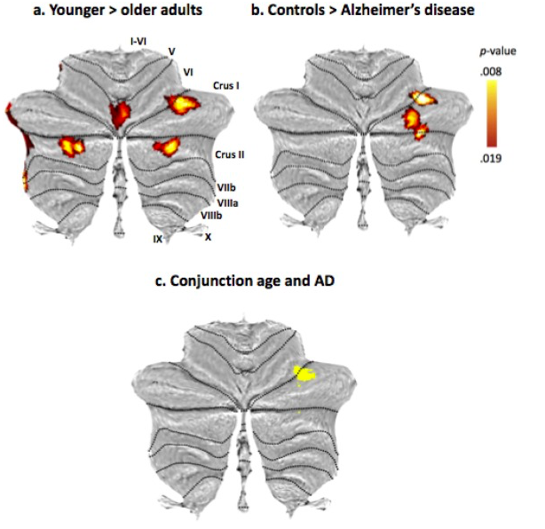 HGellersen's tweet photo. New paper out now in Neuroimage: Clinical. We show differential patterns of cerebellar grey matter loss in Alzheimer's disease and healthy aging and characterise the cognitive profile of affected regions using three functional maps of the cerebellum. https://t.co/Ic7bQPr4yv https://t.co/WC8ju7Vpum
